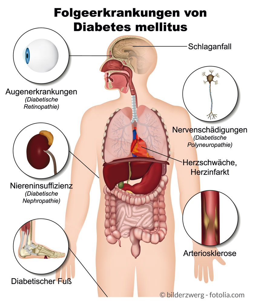 Folgeerkrankungen von Diabetes mellitus im Überblick