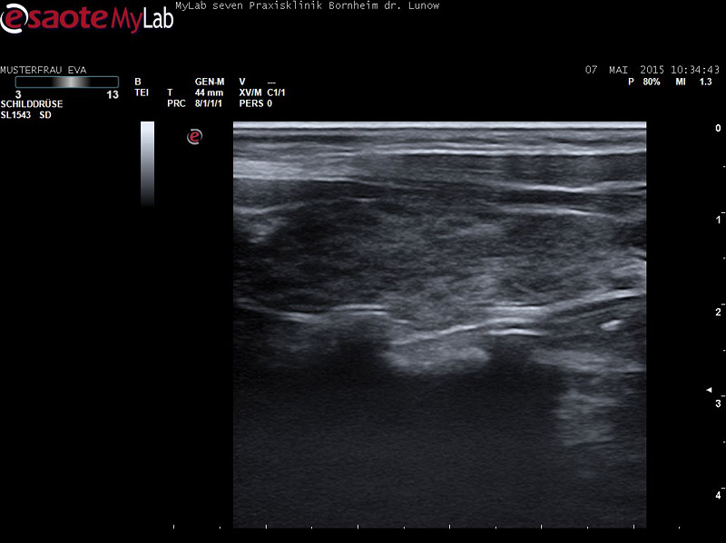 Sonographie der Schilddrüse zur Diagnose von Hashimoto Thyreoiditis | Praxisklinik Bornheim, Köln-Bonn