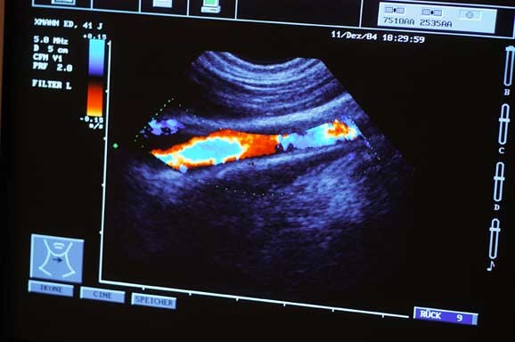Ultraschalluntersuchung / Farbdoppler-Sonographie am Bein zur Diagnose von Gefäßveränderungen und Durchblutungsstörungen | © Praxisklinik Bornheim - Swisttal