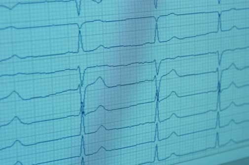 Ein EKG (Elektrokardiographie) ermöglicht in der Praxisklinik Bornheim (bei Köln - Bonn) die Diagnose von Herz-Krankheiten