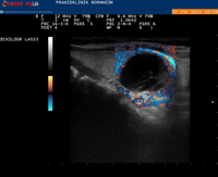 gutartiger Schilddrüsenknoten im Farbultraschall