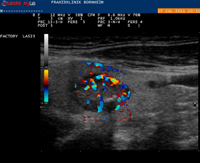 Schilddrüsenkrebs im Farbultraschall
