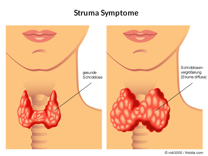 Schilddrüsenvergrößerung – Struma diffusa: Ursachen, Symptome, Therapien erklärt von Schilddrüsenspezialist Praxisklinik Bornheim bei Köln / Bonn