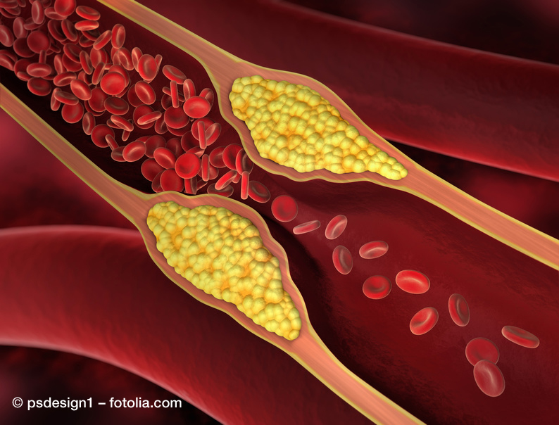 Cholesterin kann an den Gefäßwänden zu Ablagerungen führen