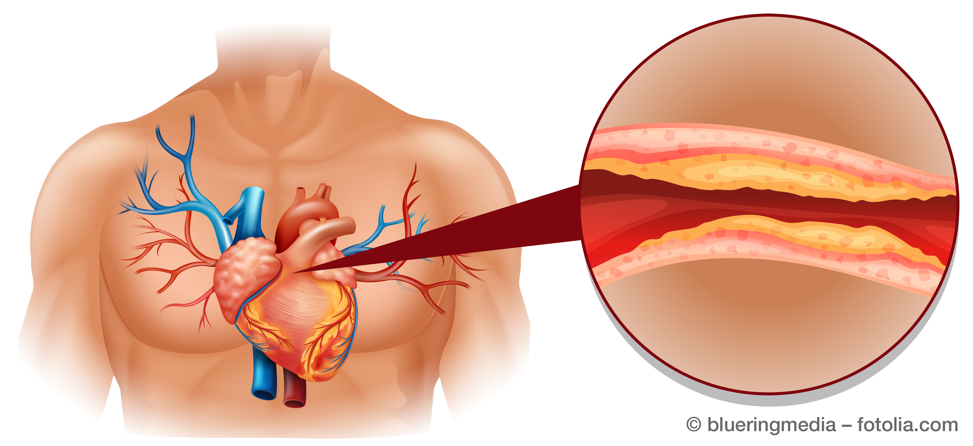Hohes Cholesterin ist die häufigste Ursache für einen Herzinfarkt