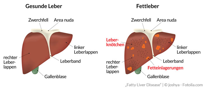 Der Übergang von gesunder Leber zu Fettleber verursacht keine typischen Symptome - deshalb wird eine Fettleber oft erst während einer Check-up-Untersuchung durch Ultraschall festgestellt. | Praxisklinik Bornhein, Köln-Bonn