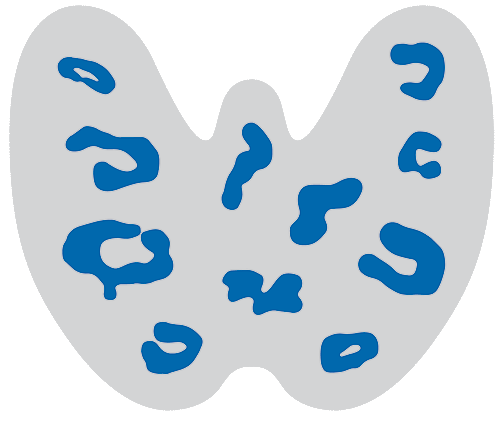 Bildliche Darstellung einer an Hashimoto-Thyreoiditis (Autoimmunkrankheit) erkankten Schilddrüse. | Praxisklink Bornheim, Köln-Bonn