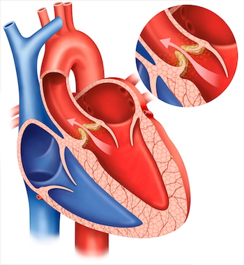 Aortenklappenstenose : Ein häufiger Herzklappenfehler
