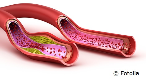 Oft unterschätzt: Die Gesundheit der Blutgefäße 
