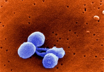 Bakterieller Lungenentzündung durch eine Pneumokokken-Infektion