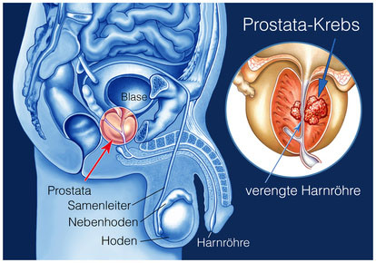 prostata tumor entfernen