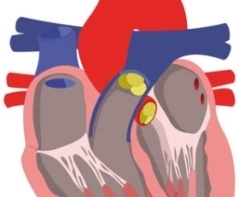 Im Winter steigt die Gefahr einer Herzmuskelentzündung