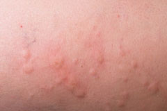 Nesselsucht: Häufige Ursache für verborgene Infekte Nesselsucht: Häufige Ursache für verborgene Infekte